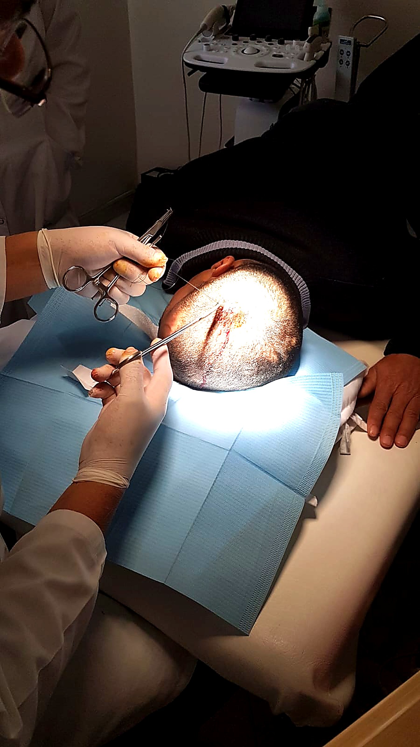 Suture après l'exérèse